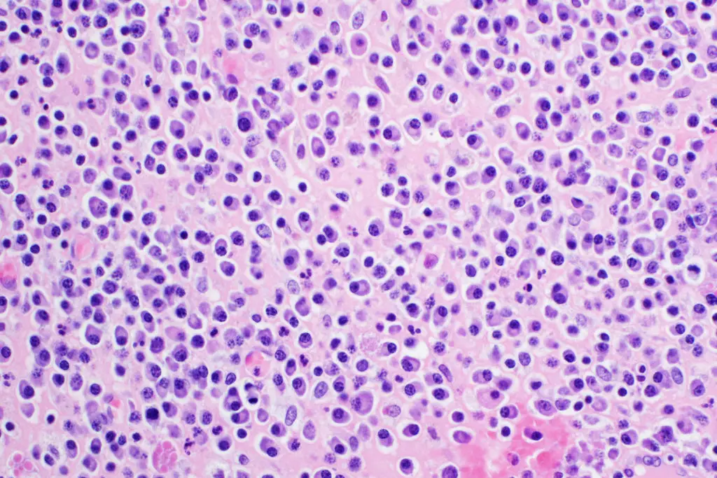 Figure. Photomicrograph of hematoxylin and eosin stain reflecting multiple myeloma.  Credit: Getty Images.