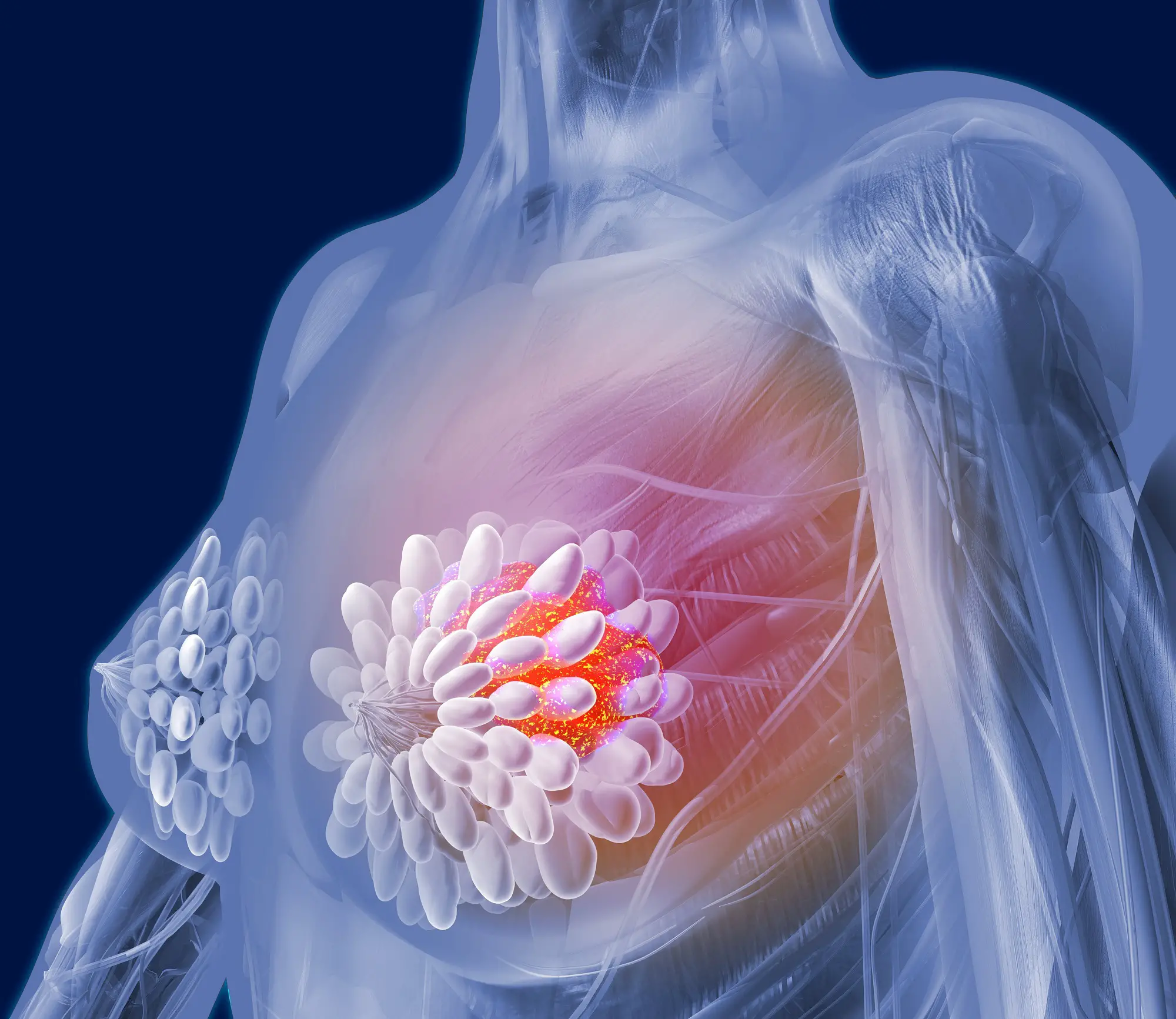 Prolonged PFS seen with ribociclib in premenopausal breast cancer