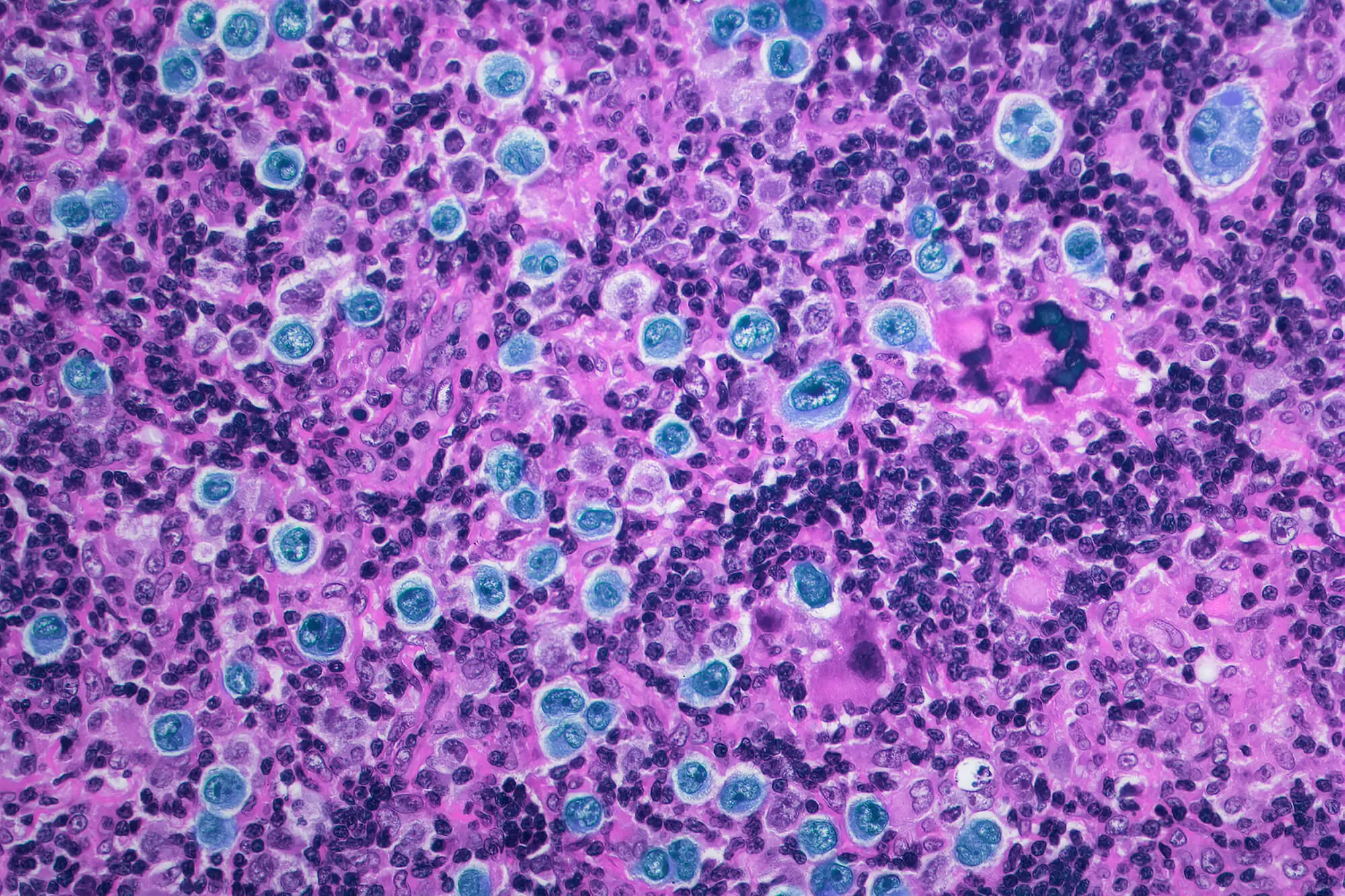 Light micrograph of large B cell lymphoma